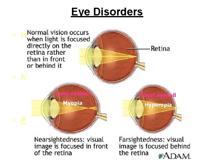 Eye Disorders • Hyperopia (far-sighted): • The image is focused behind the retina •