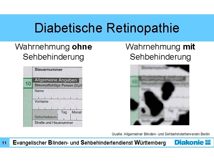 Diabetische Retinopathie Wahrnehmung ohne Sehbehinderung Wahrnehmung mit Sehbehinderung Quelle: Allgemeiner Blinden- und Sehbehindertenverein Berlin