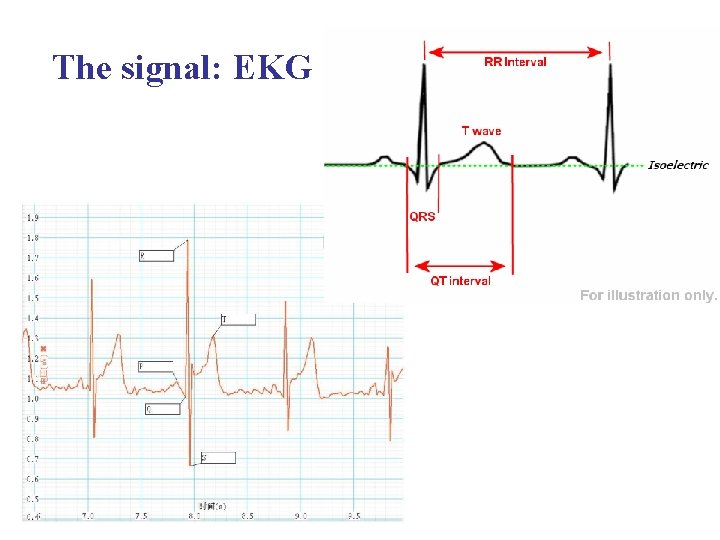 The signal: EKG 