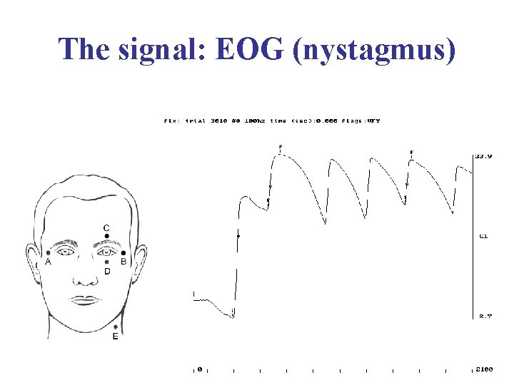 The signal: EOG (nystagmus) 