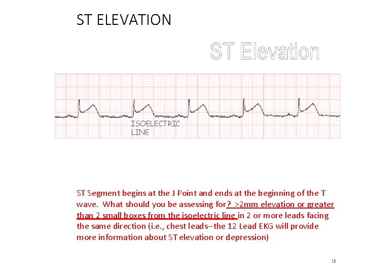 ST ELEVATION ISOELECTRIC LINE ST Segment begins at the J Point and ends at