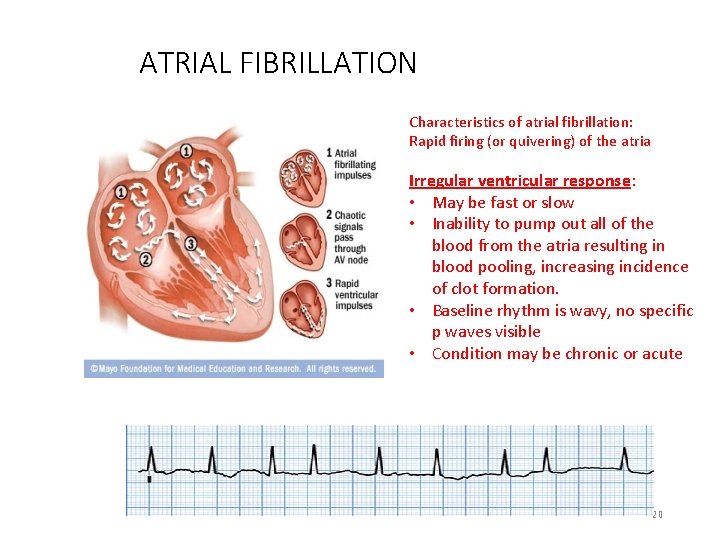 ATRIAL FIBRILLATION Characteristics of atrial fibrillation: Rapid firing (or quivering) of the atria Irregular