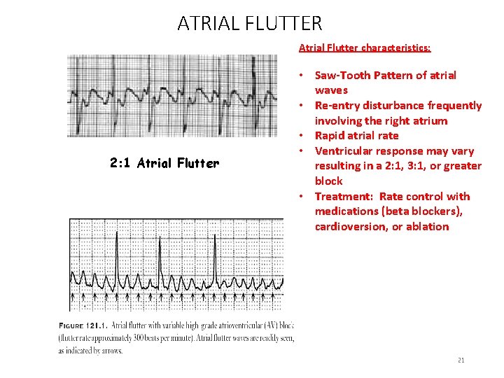 ATRIAL FLUTTER Atrial Flutter characteristics: 2: 1 Atrial Flutter • Saw-Tooth Pattern of atrial