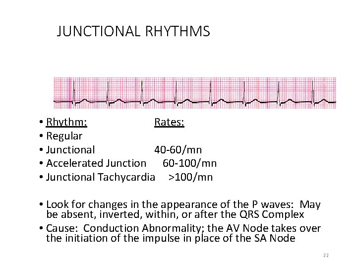JUNCTIONAL RHYTHMS • Rhythm: Rates: • Regular • Junctional 40 -60/mn • Accelerated Junction