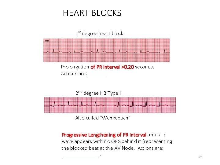 HEART BLOCKS 1 st degree heart block Prolongation of PR Interval >0. 20 seconds.