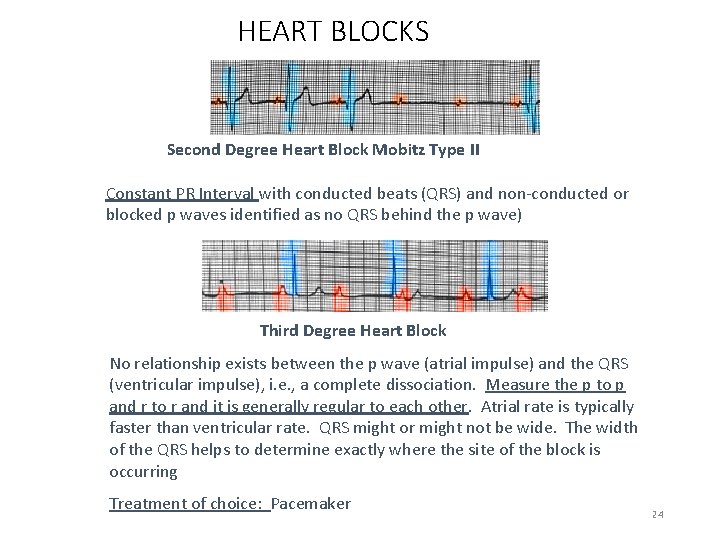 HEART BLOCKS Second Degree Heart Block Mobitz Type II Constant PR Interval with conducted