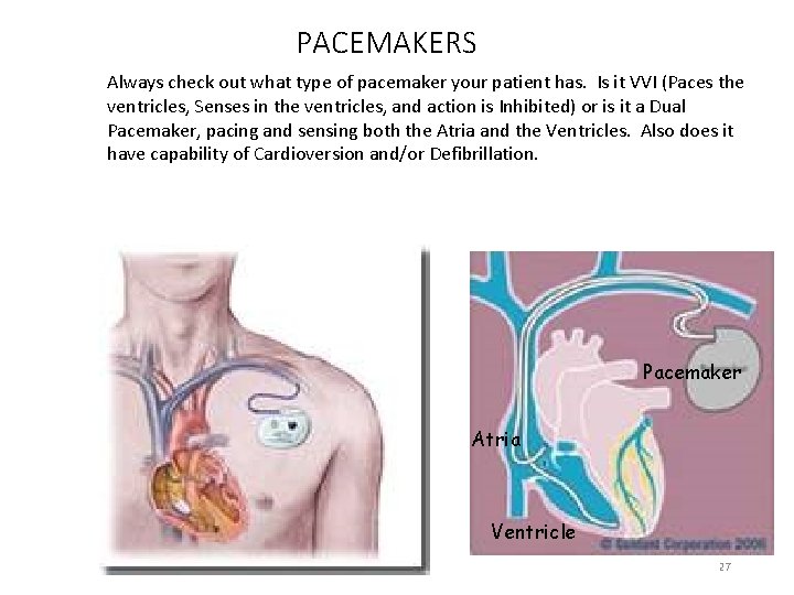PACEMAKERS Always check out what type of pacemaker your patient has. Is it VVI