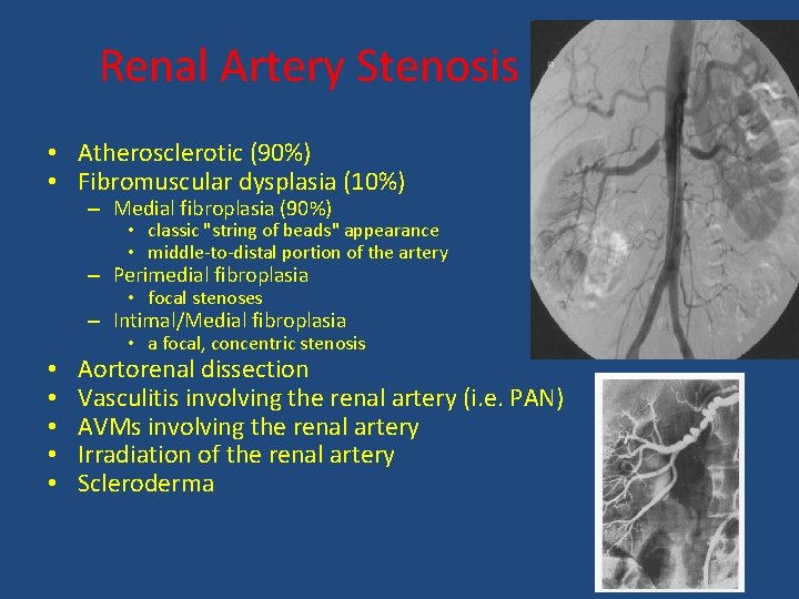 Renal Artery Stenosis • Atherosclerotic (90%) • Fibromuscular dysplasia (10%) – Medial fibroplasia (90%)