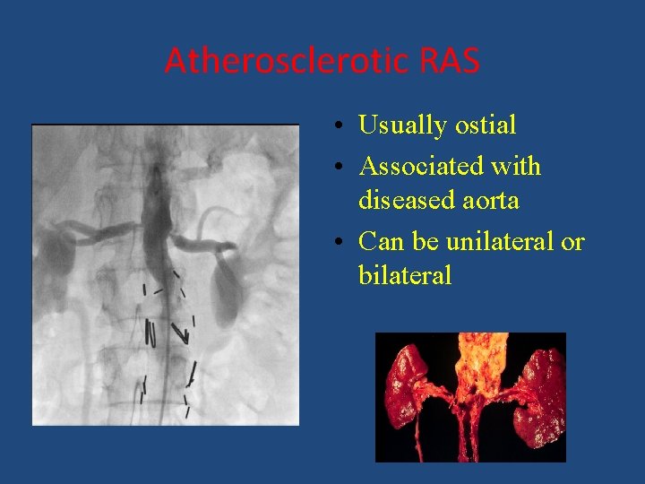 Atherosclerotic RAS • Usually ostial • Associated with diseased aorta • Can be unilateral