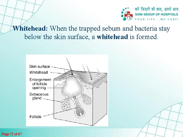 Whitehead: When the trapped sebum and bacteria stay below the skin surface, a whitehead