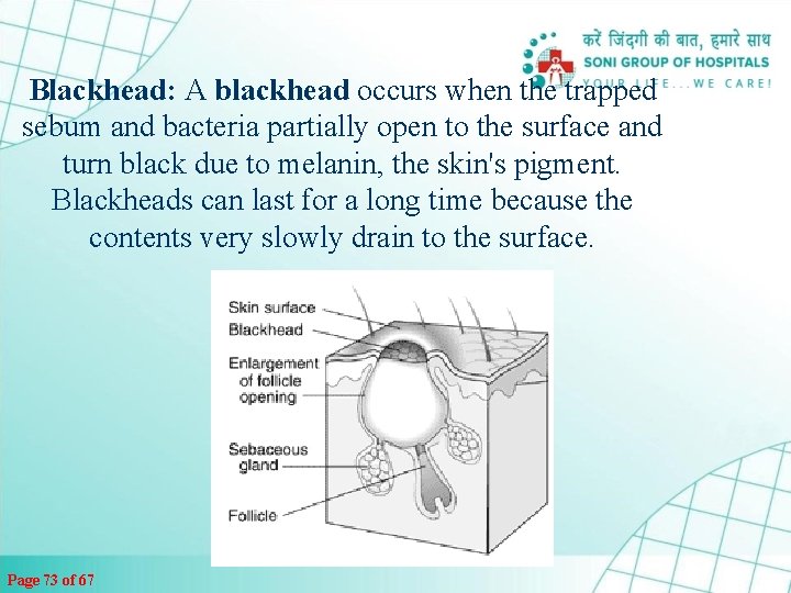 Blackhead: A blackhead occurs when the trapped sebum and bacteria partially open to the