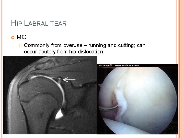 HIP LABRAL TEAR MOI: � Commonly from overuse – running and cutting; can occur HIP LABRAL TEAR MOI: � Commonly from overuse – running and cutting; can occur
