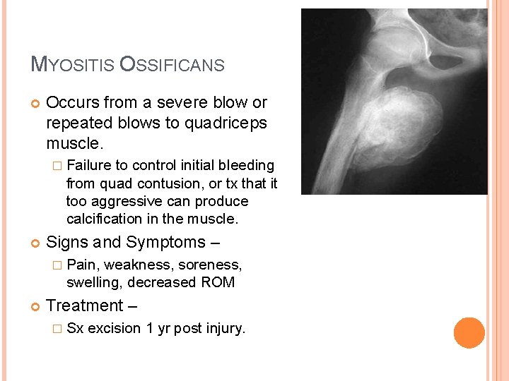 MYOSITIS OSSIFICANS Occurs from a severe blow or repeated blows to quadriceps muscle. � MYOSITIS OSSIFICANS Occurs from a severe blow or repeated blows to quadriceps muscle. �