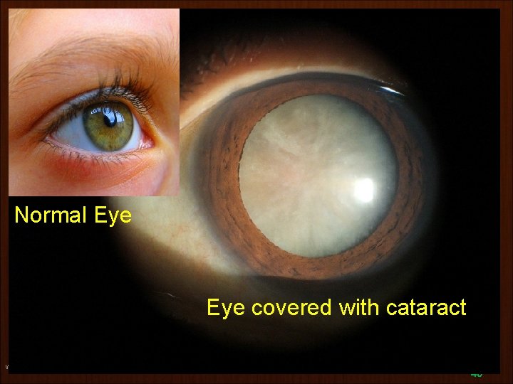 Normal Eye covered with cataract www. gokulbhajan. com Gokul Bhajan & Vedic Studies 40