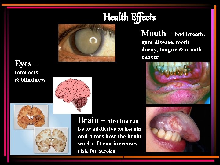 Health Effects Mouth – bad breath, gum disease, tooth decay, tongue & mouth cancer