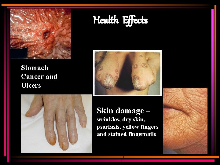 Health Effects Stomach Cancer and Ulcers Skin damage – wrinkles, dry skin, psoriasis, yellow