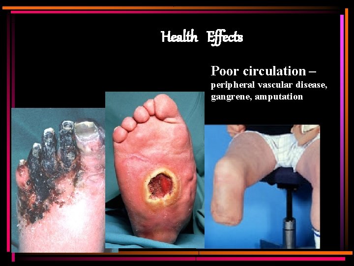 Health Effects Poor circulation – peripheral vascular disease, gangrene, amputation 