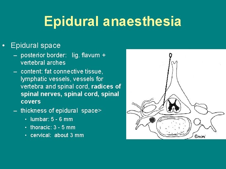 Epidural anaesthesia • Epidural space – posterior border: lig. flavum + vertebral arches –