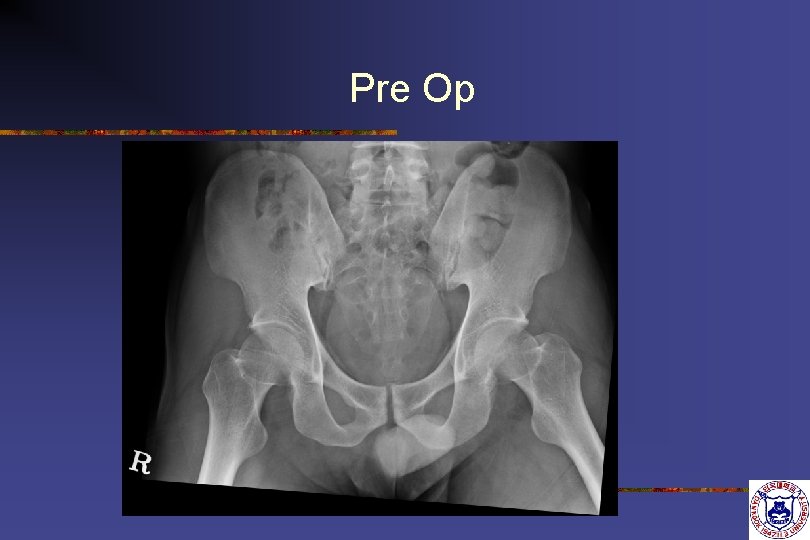 Pre Op Pre Op