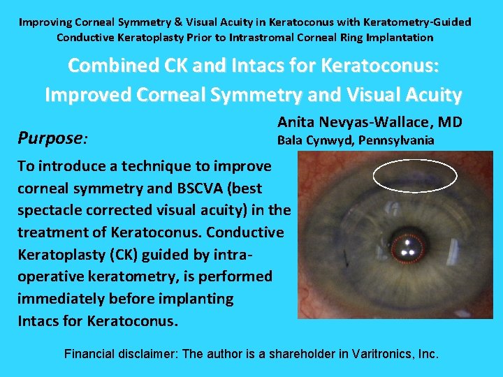 Improving Corneal Symmetry & Visual Acuity in Keratoconus with Keratometry-Guided Conductive Keratoplasty Prior to Improving Corneal Symmetry & Visual Acuity in Keratoconus with Keratometry-Guided Conductive Keratoplasty Prior to