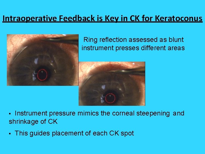 Intraoperative Feedback is Key in CK for Keratoconus Ring reflection assessed as blunt instrument Intraoperative Feedback is Key in CK for Keratoconus Ring reflection assessed as blunt instrument