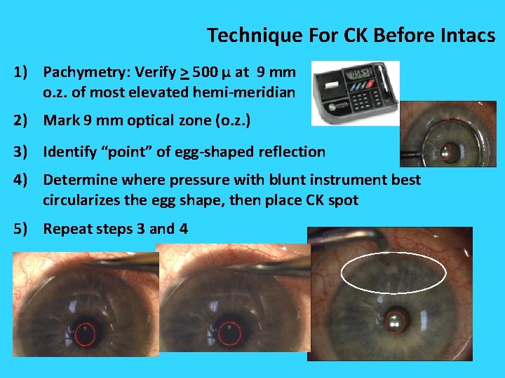Technique For CK Before Intacs 1) Pachymetry: Verify > 500 μ at 9 mm Technique For CK Before Intacs 1) Pachymetry: Verify > 500 μ at 9 mm