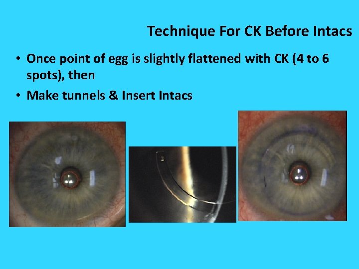 Technique For CK Before Intacs • Once point of egg is slightly flattened with Technique For CK Before Intacs • Once point of egg is slightly flattened with