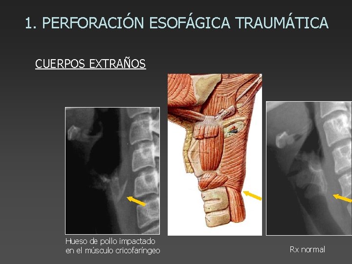 1. PERFORACIÓN ESOFÁGICA TRAUMÁTICA CUERPOS EXTRAÑOS Hueso de pollo impactado en el músculo cricofaríngeo