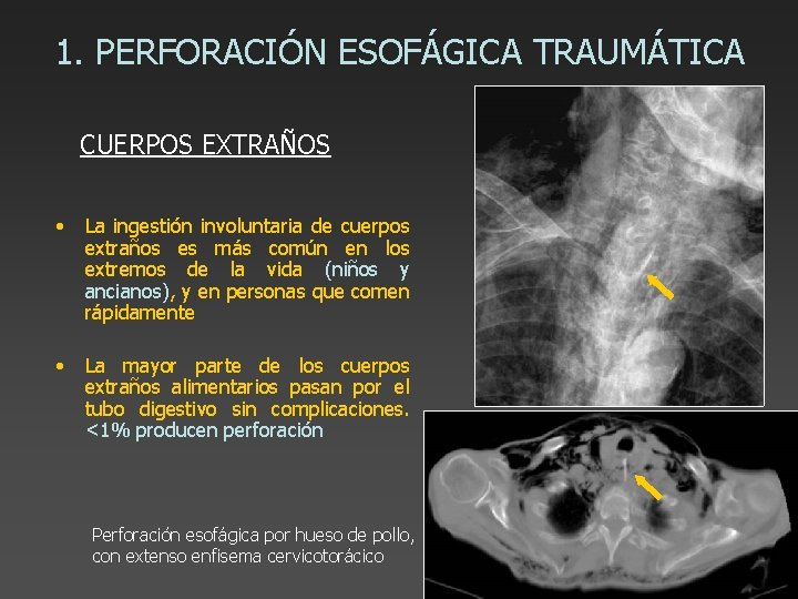 1. PERFORACIÓN ESOFÁGICA TRAUMÁTICA CUERPOS EXTRAÑOS • La ingestión involuntaria de cuerpos extraños es