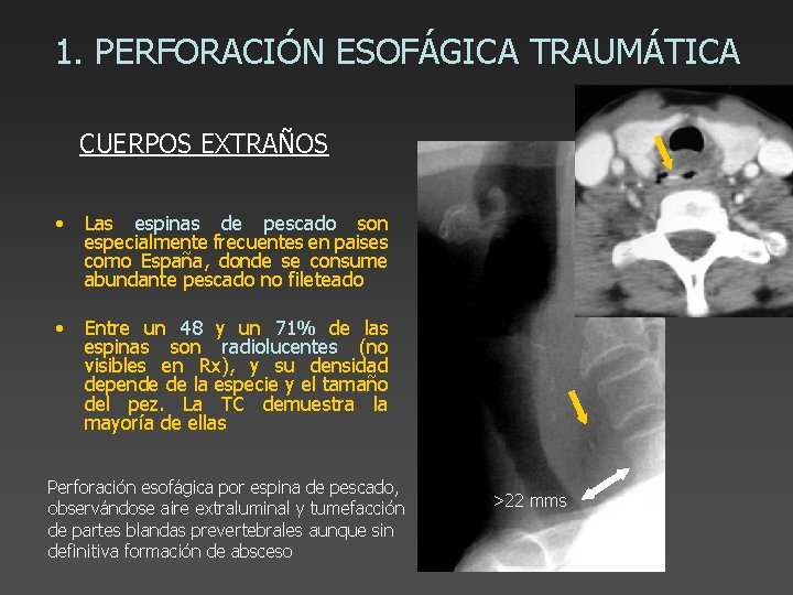 1. PERFORACIÓN ESOFÁGICA TRAUMÁTICA CUERPOS EXTRAÑOS • Las espinas de pescado son especialmente frecuentes