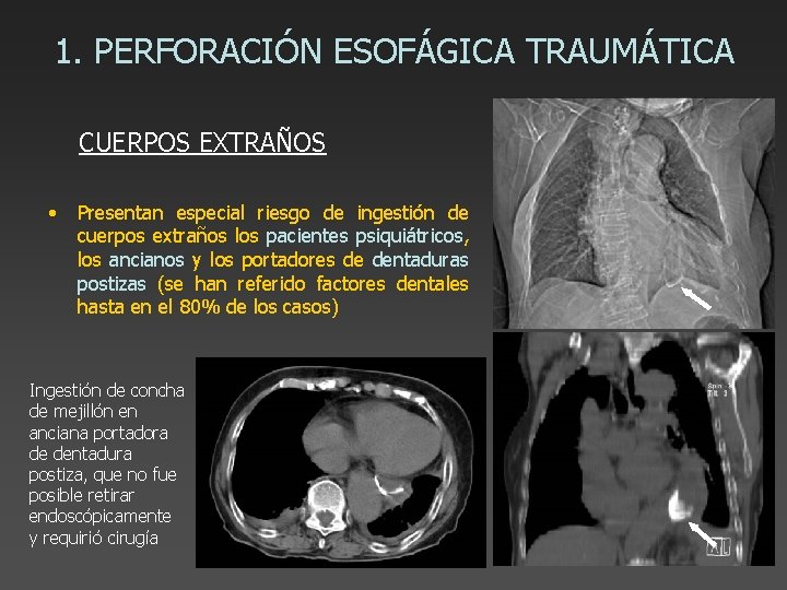 1. PERFORACIÓN ESOFÁGICA TRAUMÁTICA CUERPOS EXTRAÑOS • Presentan especial riesgo de ingestión de cuerpos