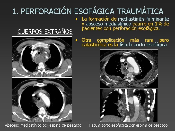 1. PERFORACIÓN ESOFÁGICA TRAUMÁTICA CUERPOS EXTRAÑOS • La formación de mediastinitis fulminante y absceso