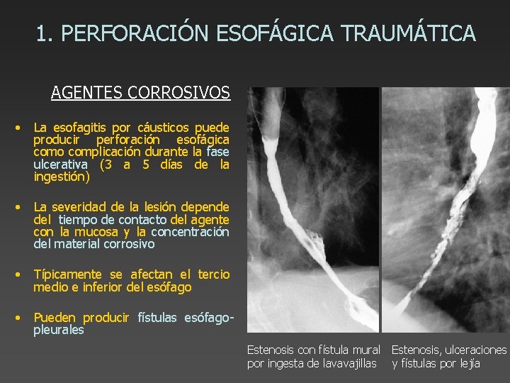 1. PERFORACIÓN ESOFÁGICA TRAUMÁTICA AGENTES CORROSIVOS • La esofagitis por cáusticos puede producir perforación