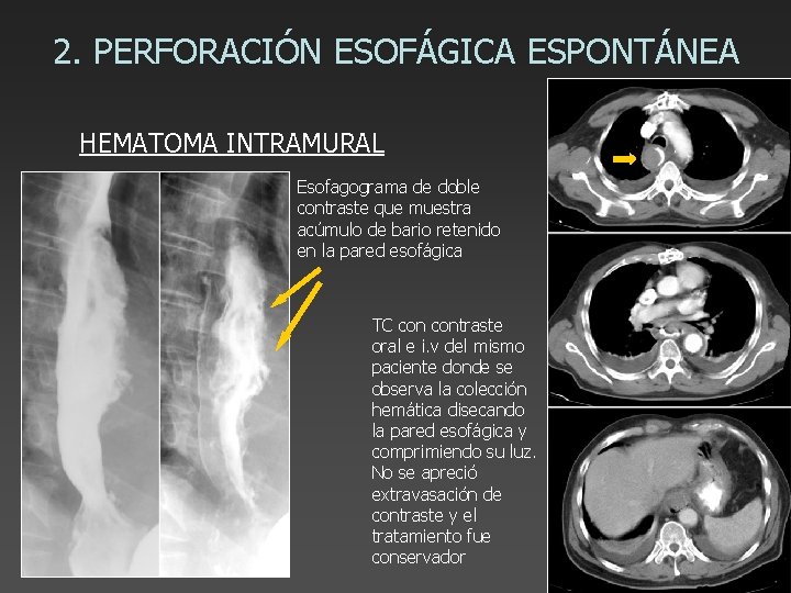 2. PERFORACIÓN ESOFÁGICA ESPONTÁNEA HEMATOMA INTRAMURAL Esofagograma de doble contraste que muestra acúmulo de