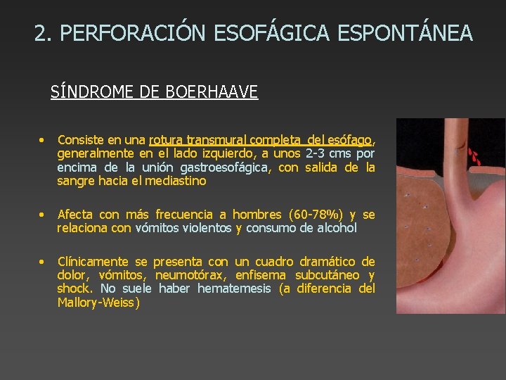 2. PERFORACIÓN ESOFÁGICA ESPONTÁNEA SÍNDROME DE BOERHAAVE • Consiste en una rotura transmural completa