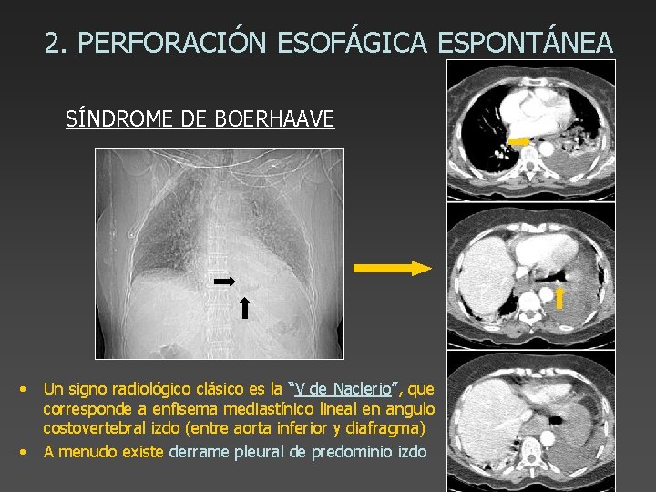 2. PERFORACIÓN ESOFÁGICA ESPONTÁNEA SÍNDROME DE BOERHAAVE • • Un signo radiológico clásico es
