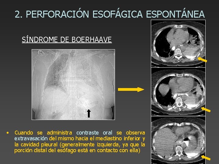 2. PERFORACIÓN ESOFÁGICA ESPONTÁNEA SÍNDROME DE BOERHAAVE • Cuando se administra contraste oral se