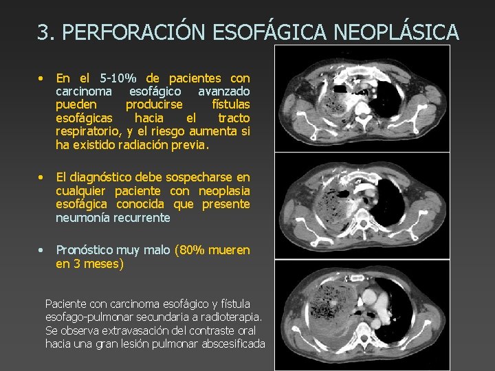 3. PERFORACIÓN ESOFÁGICA NEOPLÁSICA • En el 5 -10% de pacientes con carcinoma esofágico