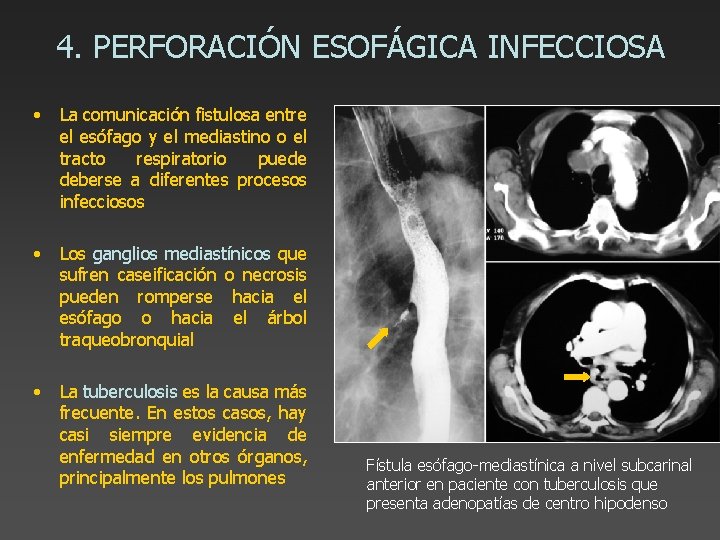 4. PERFORACIÓN ESOFÁGICA INFECCIOSA • La comunicación fistulosa entre el esófago y el mediastino