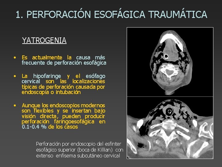 1. PERFORACIÓN ESOFÁGICA TRAUMÁTICA YATROGENIA • Es actualmente la causa más frecuente de perforación