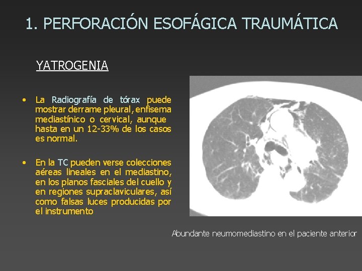 1. PERFORACIÓN ESOFÁGICA TRAUMÁTICA YATROGENIA • La Radiografía de tórax puede mostrar derrame pleural,