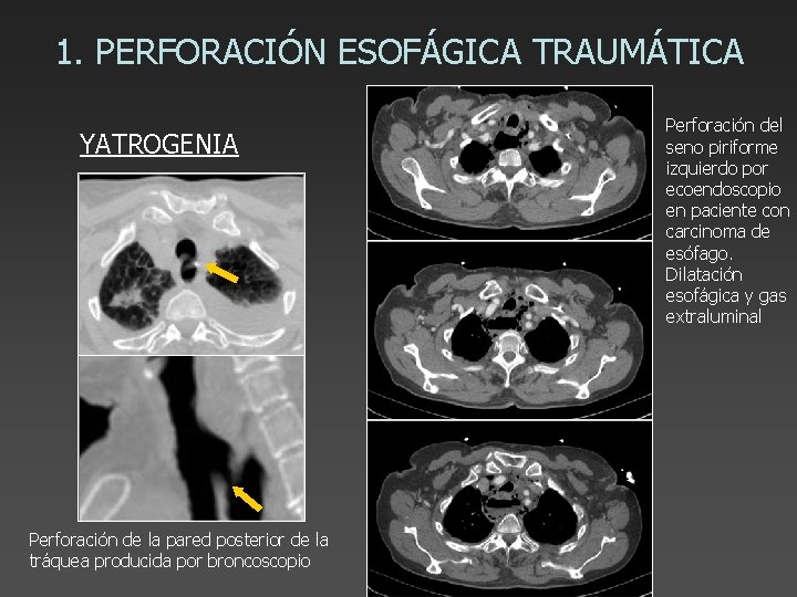 1. PERFORACIÓN ESOFÁGICA TRAUMÁTICA YATROGENIA Perforación de la pared posterior de la tráquea producida