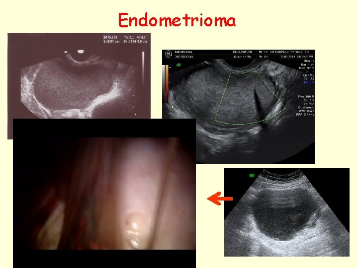 Endometrioma 