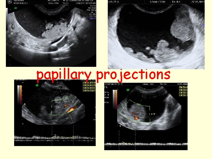 papillary projections 