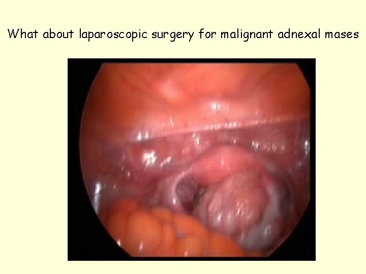 What about laparoscopic surgery for malignant adnexal mases 
