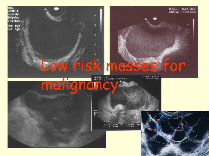 Low risk masses for malignancy 