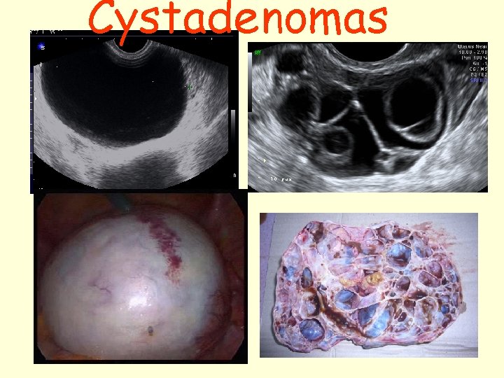 Cystadenomas 