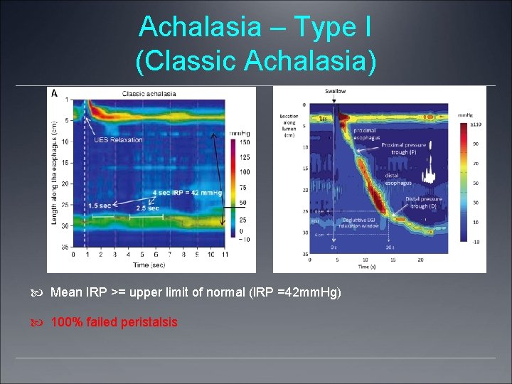 Achalasia – Type I (Classic Achalasia) Mean IRP >= upper limit of normal (IRP