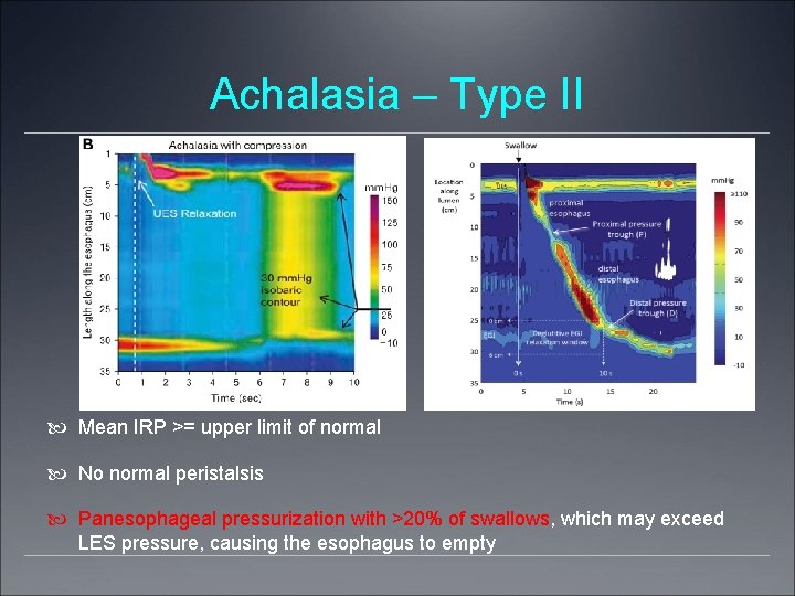 Achalasia – Type II Mean IRP >= upper limit of normal No normal peristalsis