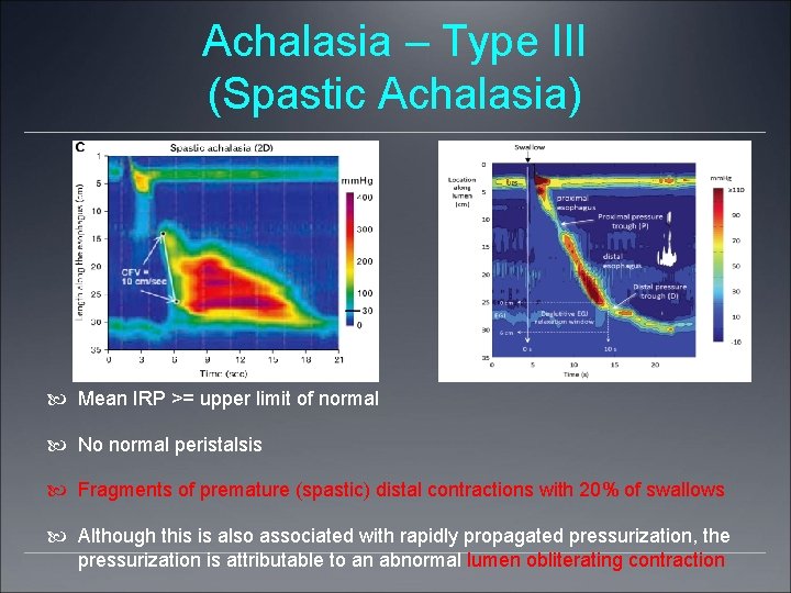Achalasia – Type III (Spastic Achalasia) Mean IRP >= upper limit of normal No